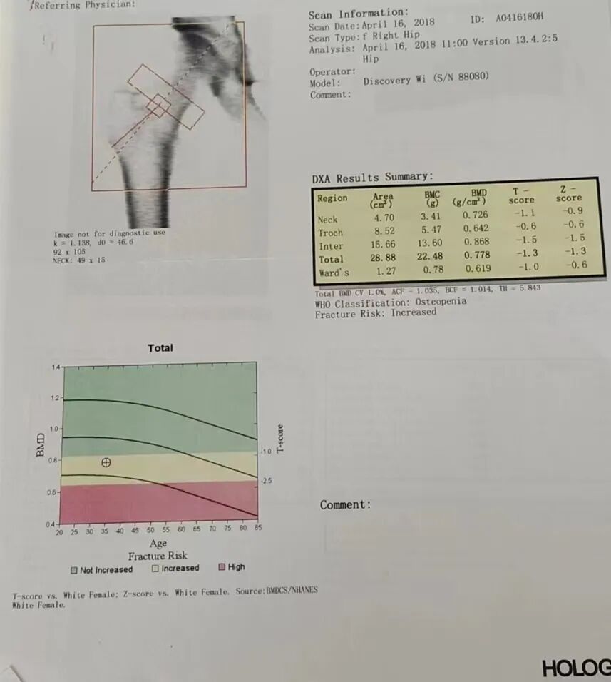 骨密度影是什么甲状腺癌全身多发转移病例（肺 骨 脑）_https://www.jmylbn.com_新闻资讯_第7张