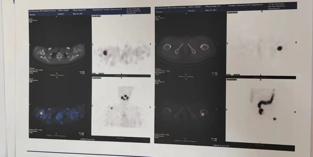 骨密度影是什么甲状腺癌全身多发转移病例（肺 骨 脑）_https://www.jmylbn.com_新闻资讯_第16张