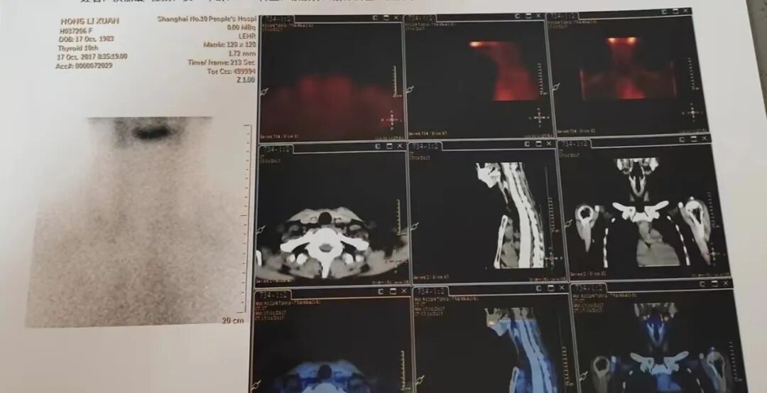 骨密度影是什么甲状腺癌全身多发转移病例（肺 骨 脑）_https://www.jmylbn.com_新闻资讯_第11张