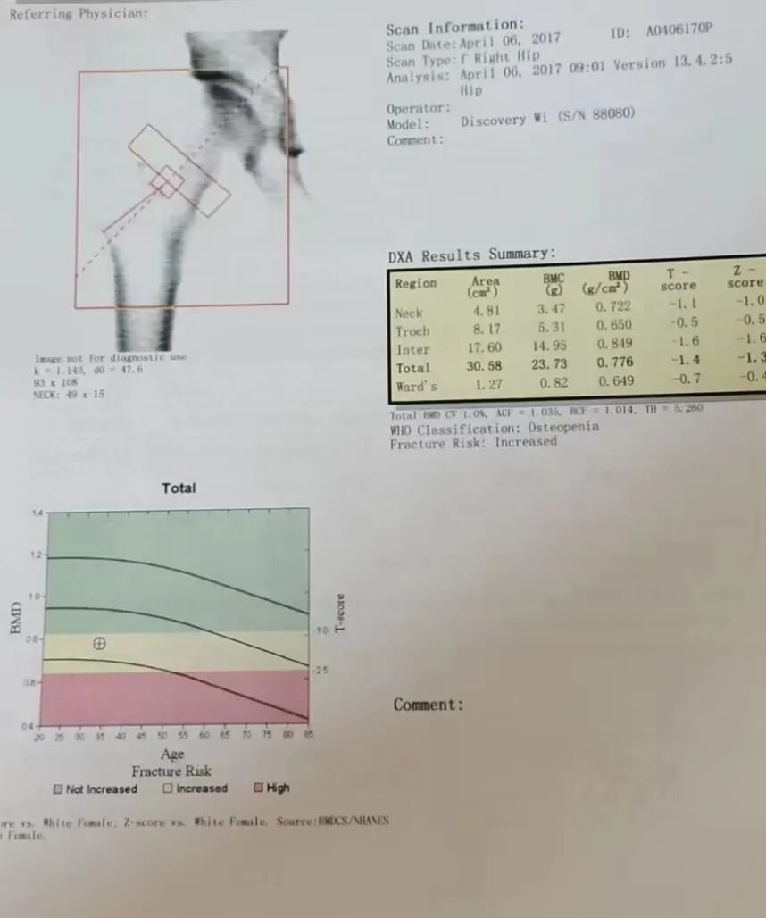 骨密度影是什么甲状腺癌全身多发转移病例（肺 骨 脑）_https://www.jmylbn.com_新闻资讯_第2张