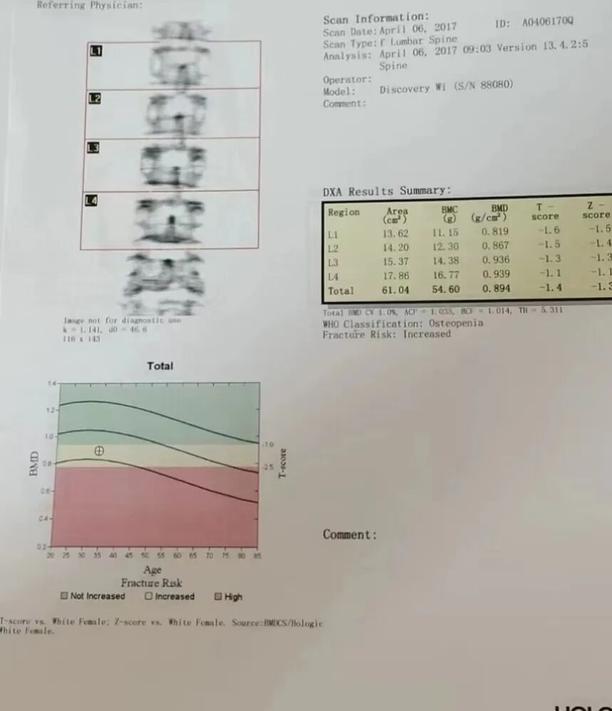 骨密度影是什么甲状腺癌全身多发转移病例（肺 骨 脑）_https://www.jmylbn.com_新闻资讯_第3张