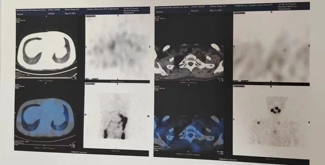 骨密度影是什么甲状腺癌全身多发转移病例（肺 骨 脑）_https://www.jmylbn.com_新闻资讯_第17张