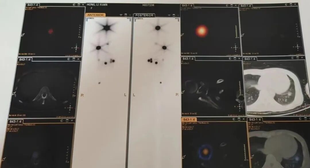 骨密度影是什么甲状腺癌全身多发转移病例（肺 骨 脑）_https://www.jmylbn.com_新闻资讯_第5张