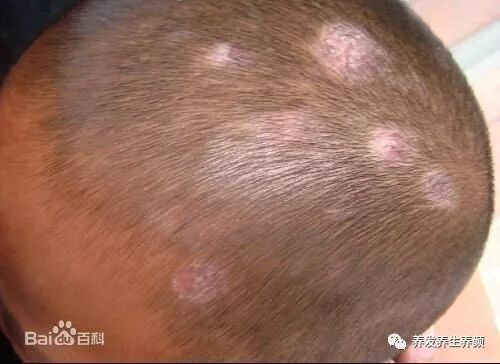 脂溢性皮炎的头皮屑防治！