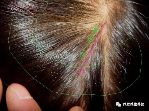 套在头发上的污白点是什么？