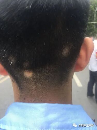 为什么会出现斑秃