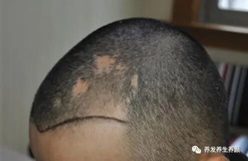 为什么疤痕性脱发要做毛发移植手术