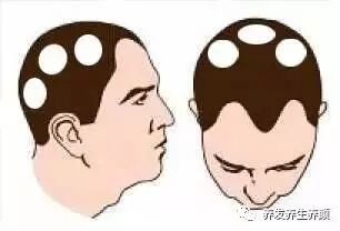 斑秃类型的医学分析