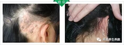 疤痕性脱发的原因与治疗！