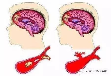 臨床中手麻原因的分析 健康 第7張