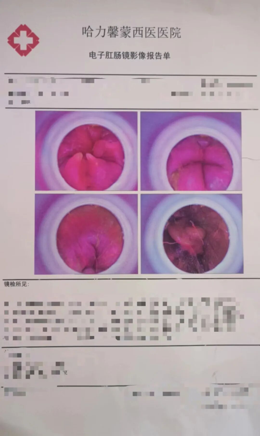 中药熏蒸机怎么放哈力馨蒙西医医院引进最新一代熏蒸治疗机和肛肠治疗综合仪，为肛肠妇科患者健康保驾护航！_https://www.jmylbn.com_新闻资讯_第6张