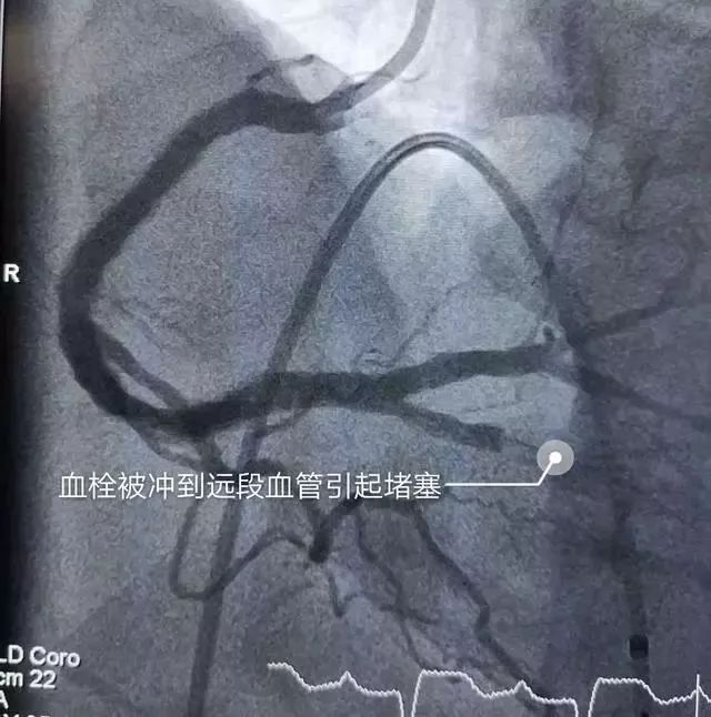 熱水澡泡出