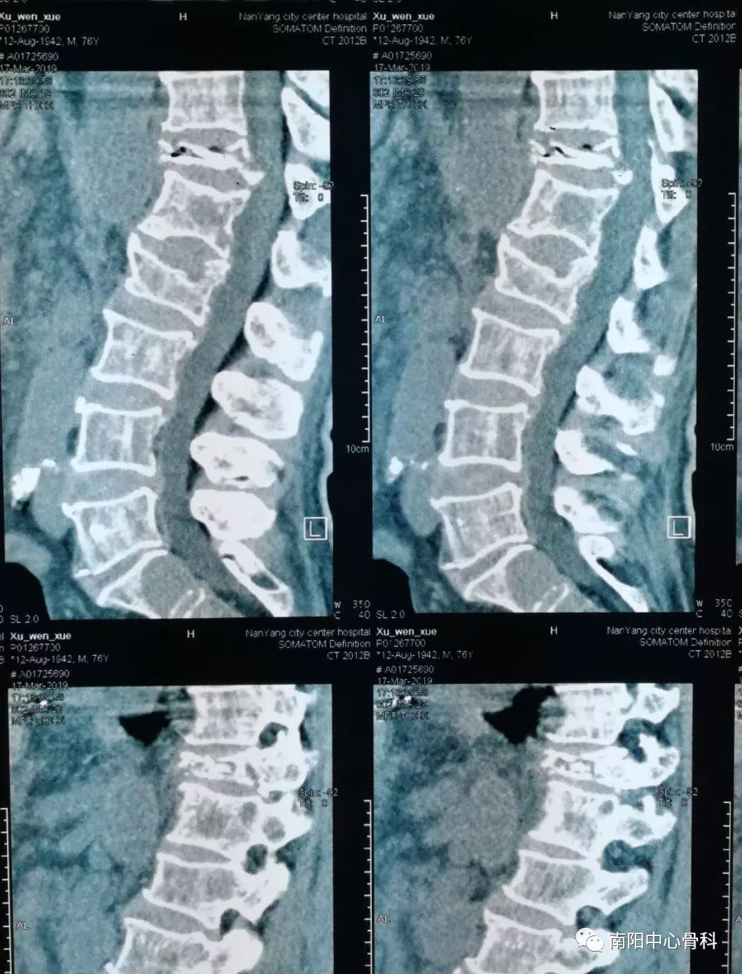 影像报告的腰椎间盘突出与腰椎间盘突出症不是一回事