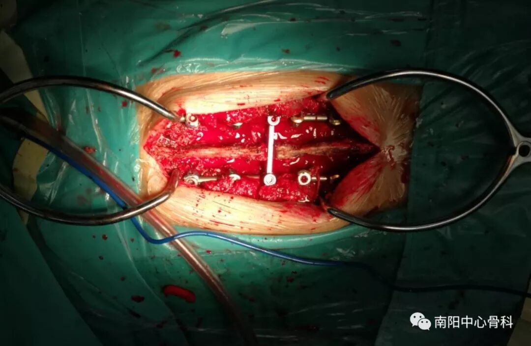 kummell病(创伤后椎体迟发性骨坏死)的临床治疗 - 好大夫在线