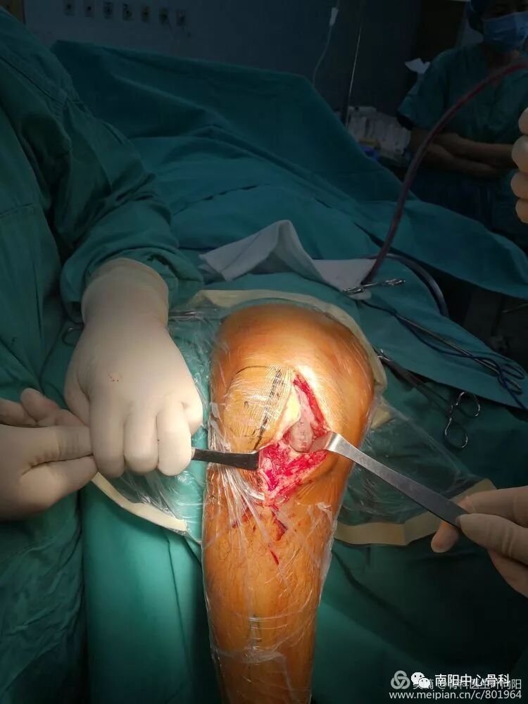 可见内侧股骨髁及平台软骨磨损,外侧间室及髌股关节,前交叉韧带完好