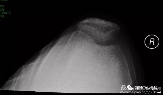三,术前30度髌骨轴位