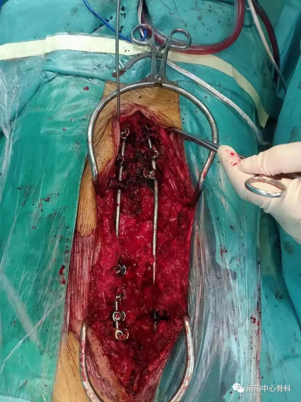 一例神经纤维瘤病脊柱侧弯的手术矫形治疗