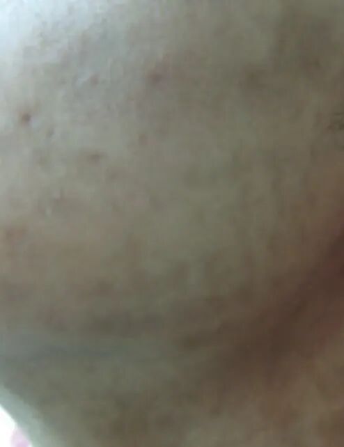 什么是光电治疗光电项目后为何会“反黑”？这些治疗方法超有效_https://www.jmylbn.com_新闻资讯_第2张