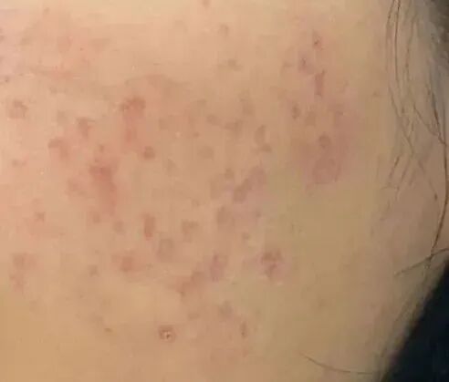 什么是光电治疗光电项目后为何会“反黑”？这些治疗方法超有效_https://www.jmylbn.com_新闻资讯_第1张