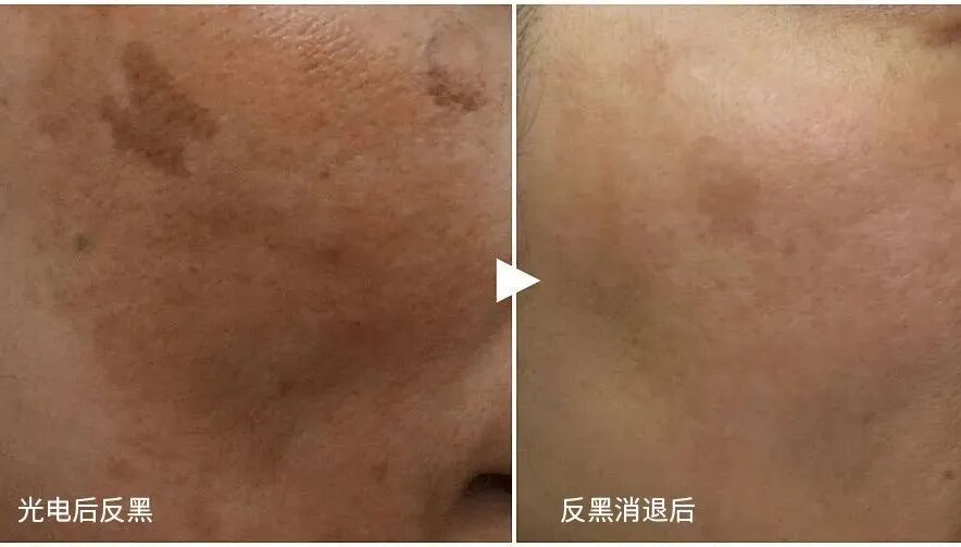 什么是光电治疗光电项目后为何会“反黑”？这些治疗方法超有效_https://www.jmylbn.com_新闻资讯_第3张