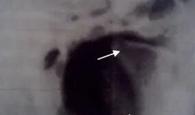 曲面断层片怎么看正畸【曲面断层片（全景片）】如何解读和查看：牙周？牙体？牙髓？关节？_https://www.jmylbn.com_新闻资讯_第31张