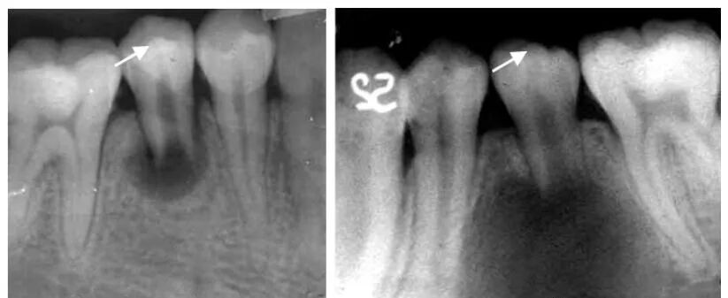 曲面断层片怎么看正畸【曲面断层片（全景片）】如何解读和查看：牙周？牙体？牙髓？关节？_https://www.jmylbn.com_新闻资讯_第16张