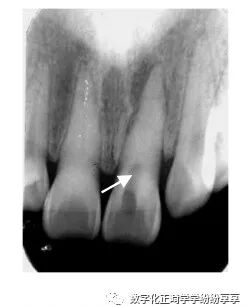 曲面断层片怎么看正畸【曲面断层片（全景片）】如何解读和查看：牙周？牙体？牙髓？关节？_https://www.jmylbn.com_新闻资讯_第6张