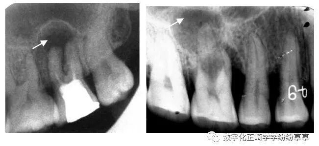 曲面断层片怎么看正畸【曲面断层片（全景片）】如何解读和查看：牙周？牙体？牙髓？关节？_https://www.jmylbn.com_新闻资讯_第9张