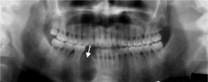 曲面断层片怎么看正畸【曲面断层片（全景片）】如何解读和查看：牙周？牙体？牙髓？关节？_https://www.jmylbn.com_新闻资讯_第10张