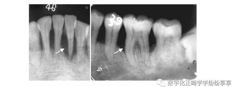 曲面断层片怎么看正畸【曲面断层片（全景片）】如何解读和查看：牙周？牙体？牙髓？关节？_https://www.jmylbn.com_新闻资讯_第15张