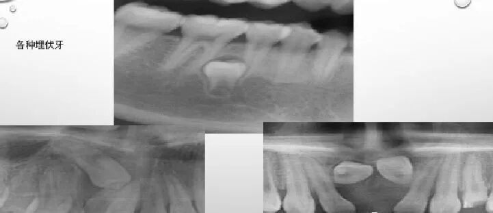 曲面断层片怎么看正畸【曲面断层片（全景片）】如何解读和查看：牙周？牙体？牙髓？关节？_https://www.jmylbn.com_新闻资讯_第2张