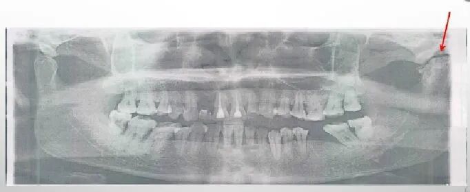 曲面断层片怎么看正畸【曲面断层片（全景片）】如何解读和查看：牙周？牙体？牙髓？关节？_https://www.jmylbn.com_新闻资讯_第26张