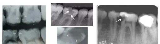 曲面断层片怎么看正畸【曲面断层片（全景片）】如何解读和查看：牙周？牙体？牙髓？关节？_https://www.jmylbn.com_新闻资讯_第3张