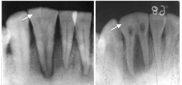 曲面断层片怎么看正畸【曲面断层片（全景片）】如何解读和查看：牙周？牙体？牙髓？关节？_https://www.jmylbn.com_新闻资讯_第18张