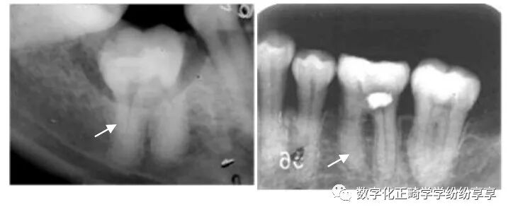 曲面断层片怎么看正畸【曲面断层片（全景片）】如何解读和查看：牙周？牙体？牙髓？关节？_https://www.jmylbn.com_新闻资讯_第11张