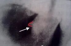 曲面断层片怎么看正畸【曲面断层片（全景片）】如何解读和查看：牙周？牙体？牙髓？关节？_https://www.jmylbn.com_新闻资讯_第32张