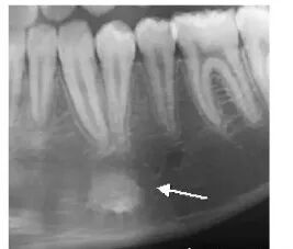 曲面断层片怎么看正畸【曲面断层片（全景片）】如何解读和查看：牙周？牙体？牙髓？关节？_https://www.jmylbn.com_新闻资讯_第23张