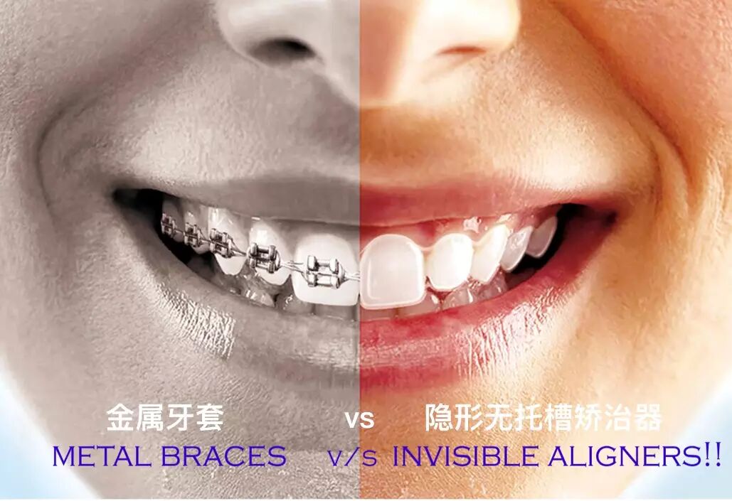 贝致社区 矫正入门 > 牙套的种类与价格无托槽隐形矫治技术是根据每个