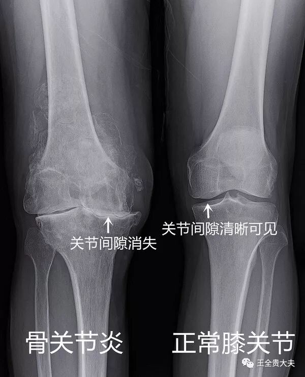 骨关节疾病问题你知道多少 王全贵大夫 微信公众号文章阅读 Wemp
