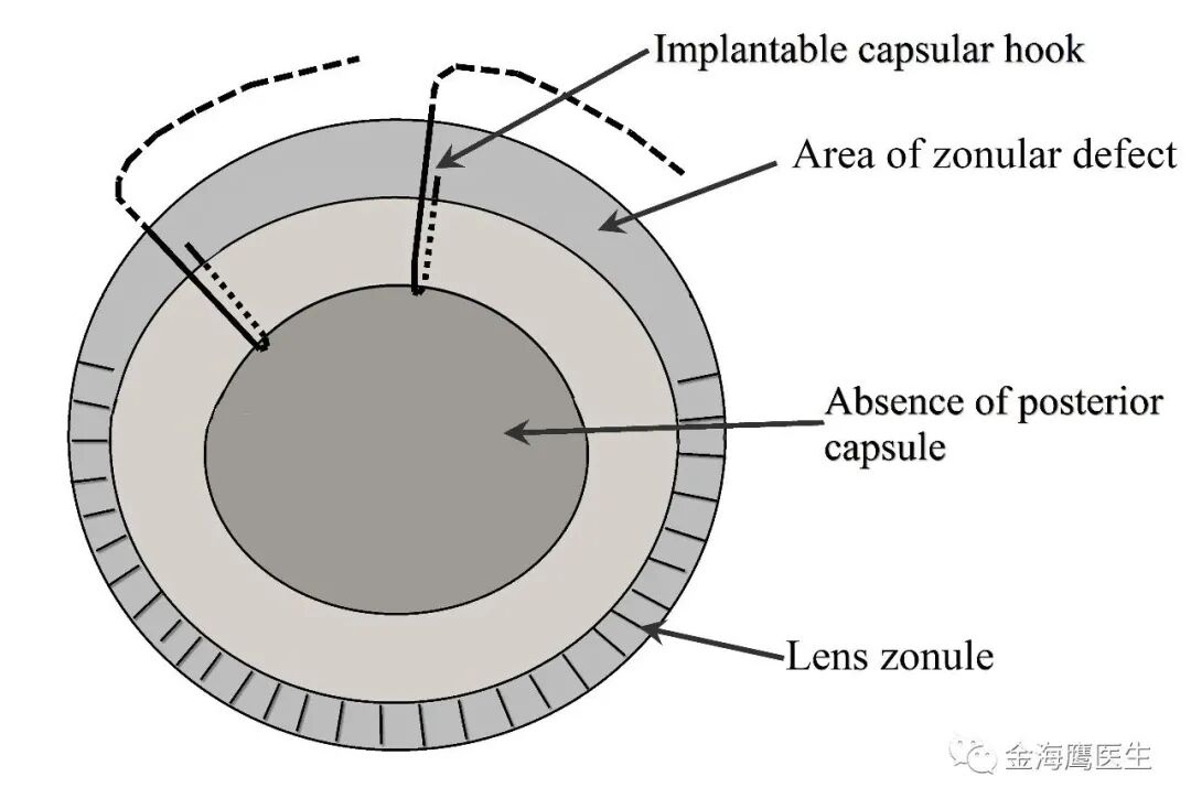 手术拉钩怎么拉更加简便的晶状体脱位手术方式--植入性囊袋拉钩_https://www.jmylbn.com_新闻资讯_第1张
