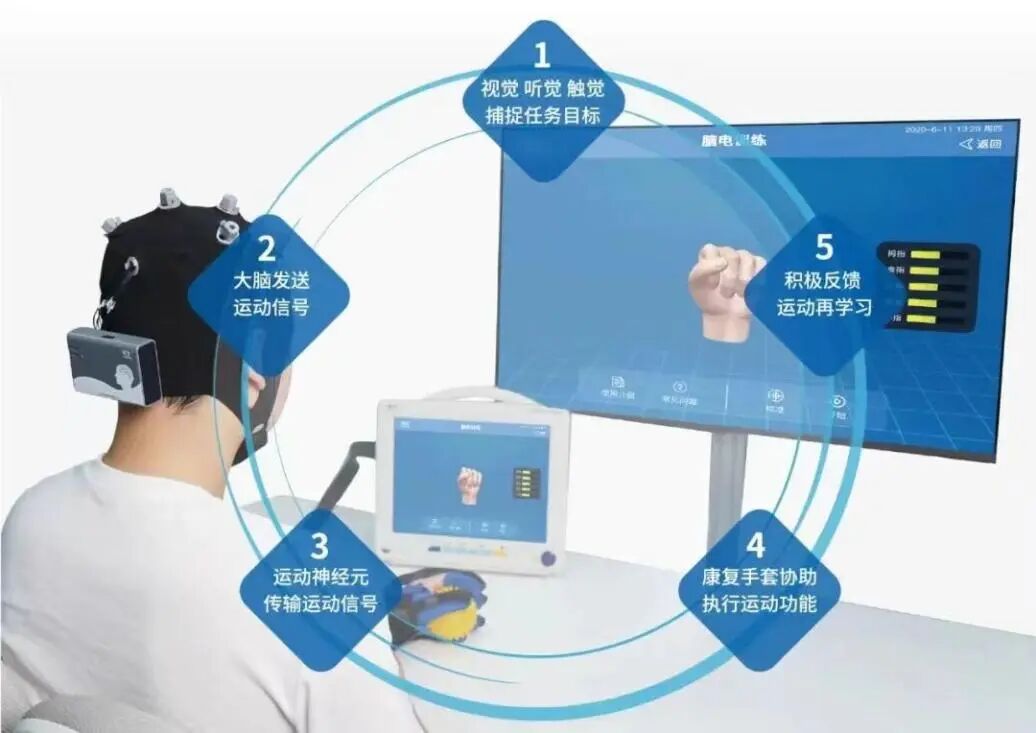什么是康复机器人“意念操控”！脑机接口机器人助力脑卒中患者康复_https://www.jmylbn.com_新闻资讯_第5张