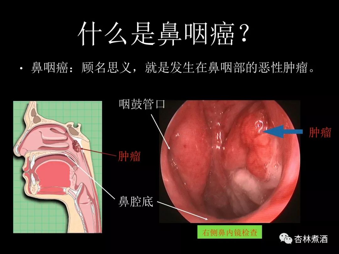 你以為是上火，其實是癌症！醫生曝光的這個病例為所有人敲響警鐘！ 健康 第2張