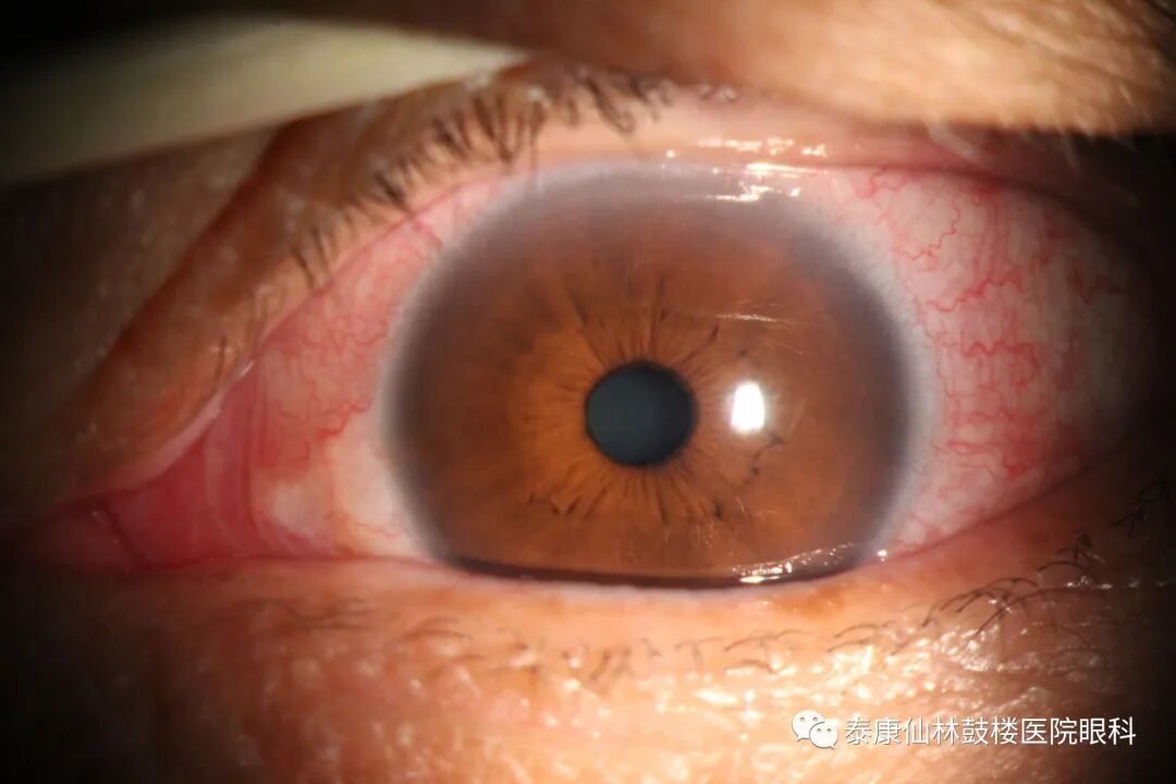 眼前节照相怎么照常见眼前段疾病一览_https://www.jmylbn.com_新闻资讯_第3张