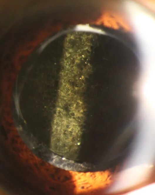 眼前节照相怎么照常见眼前段疾病一览_https://www.jmylbn.com_新闻资讯_第12张