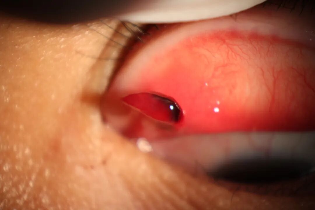 眼前节照相怎么照常见眼前段疾病一览_https://www.jmylbn.com_新闻资讯_第2张