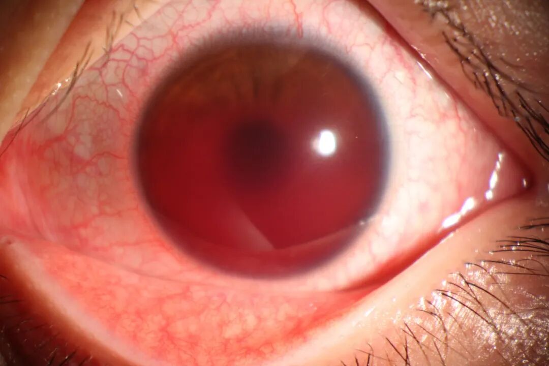 眼前节照相怎么照常见眼前段疾病一览_https://www.jmylbn.com_新闻资讯_第9张