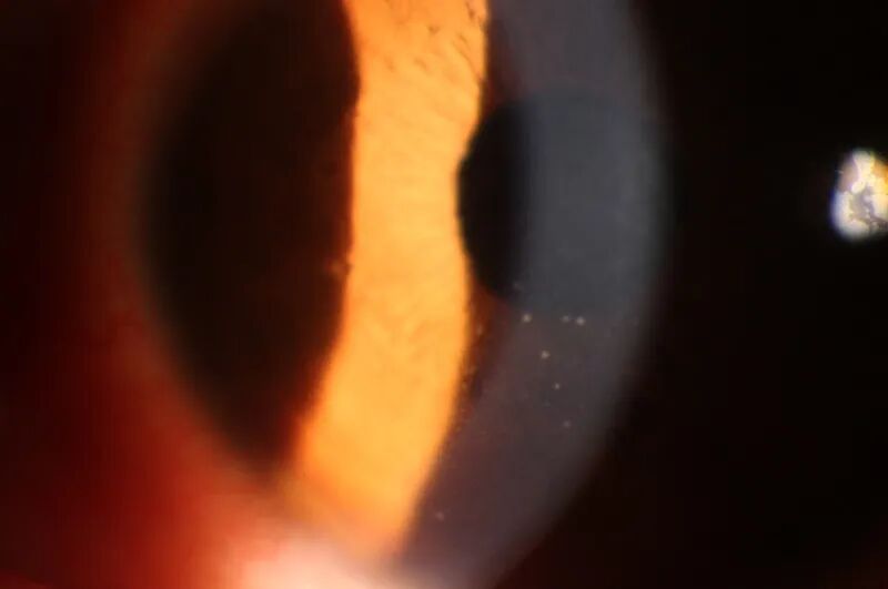 眼前节照相怎么照常见眼前段疾病一览_https://www.jmylbn.com_新闻资讯_第8张