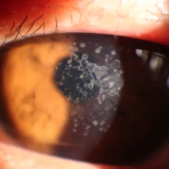 眼前节照相怎么照常见眼前段疾病一览_https://www.jmylbn.com_新闻资讯_第7张