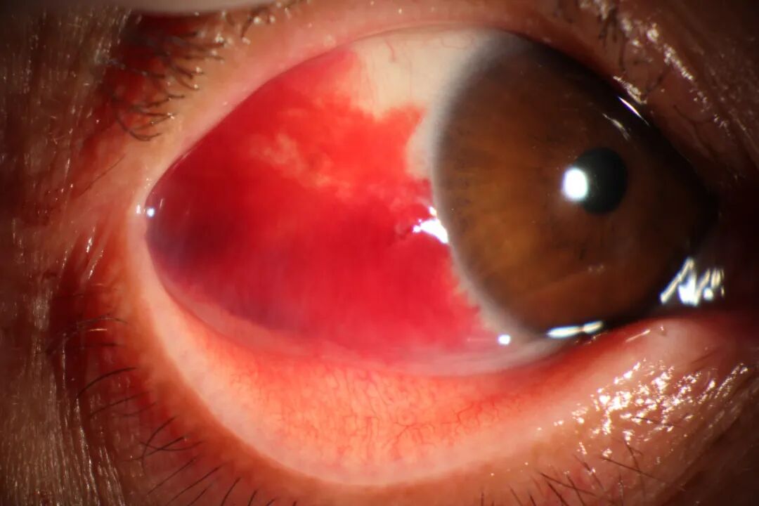 眼前节照相怎么照常见眼前段疾病一览_https://www.jmylbn.com_新闻资讯_第4张