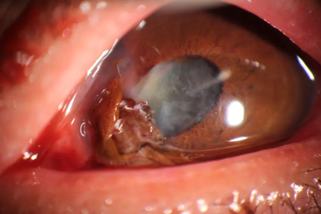 眼前节照相怎么照常见眼前段疾病一览_https://www.jmylbn.com_新闻资讯_第16张